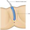 External Female Urinary Catheter: Implementation in the Emergency  Department - Journal of Emergency Nursing