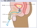 Indwelling urinary catheter insertion 1: children and young people |  Nursing Times