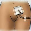 Care of Suprapubic Catheter • preop.com
